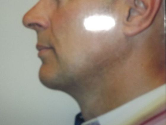 Chin Augmentation Case 2 - After
