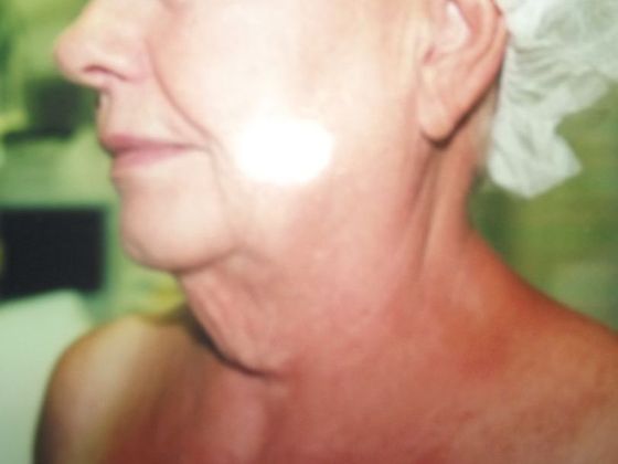 Chin Augmentation: Case 3 - Before