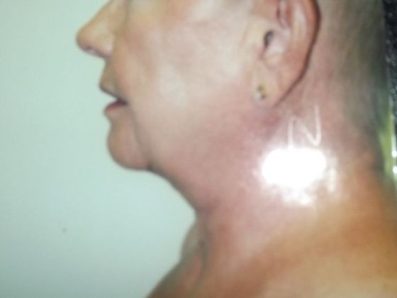 Chin Augmentation: Case 3 - After