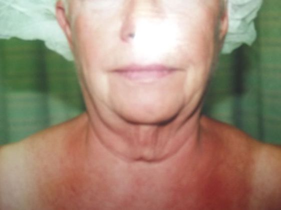 Chin Augmentation: Case 3 - Before