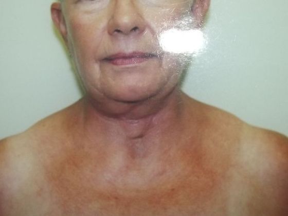 Chin Augmentation: Case 3 - Before