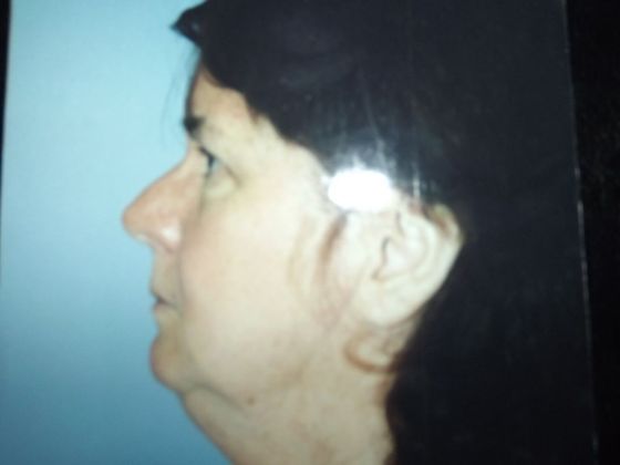 Chin Augmentation Case 4 - Before