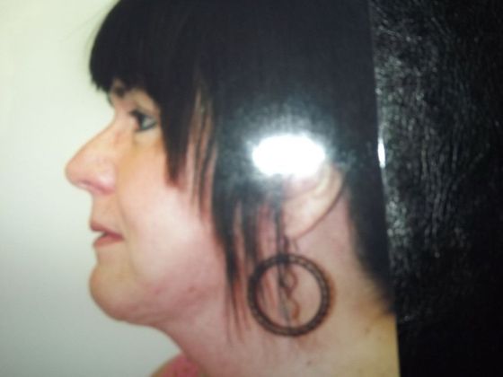 Chin Augmentation Case 4 - After