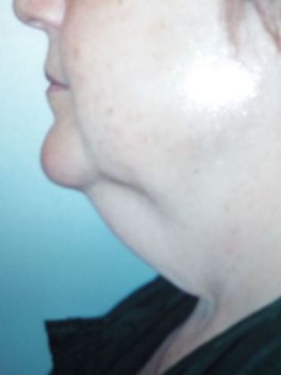 Chin Augmentation: Case 6 - Before