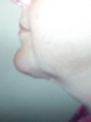 Chin Augmentation: Case 6 - After