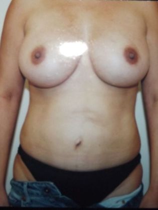 Abdominoplasty Case 4 - After