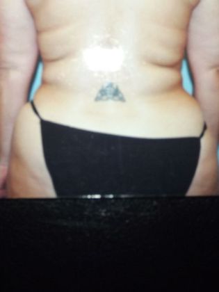 Body Contouring: Case 2 - After