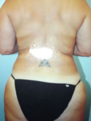 Body Contouring: Case 2 - After