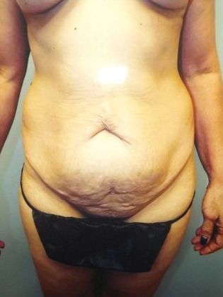 Abdominoplasty: Case 5 - Before
