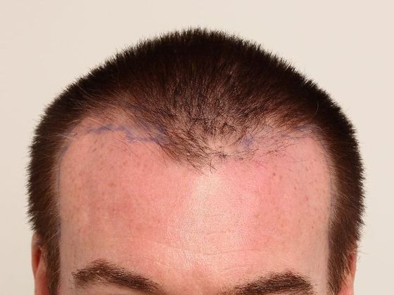 Hair Transplant - Male: Frontal FUE - Case 27 - Before FUE hair transplant