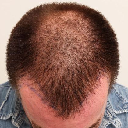 Hair Transplant - Male: Frontal FUE - Case 27 - Before FUE hair transplant