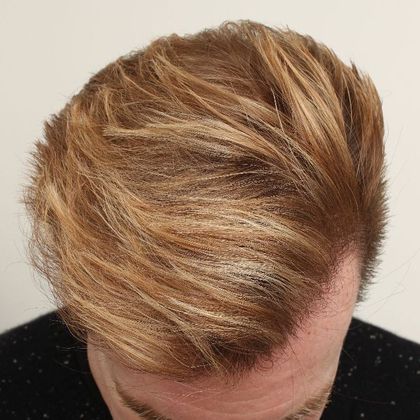 Hair Transplant - Male: Frontal FUE - Case 27 - After FUE hair transplant