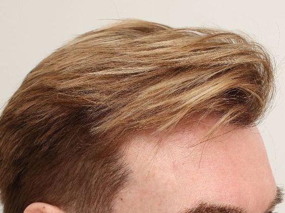 Male Before And After Hair Transplant Photos Frontal FUE (4) - After