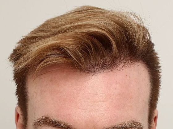 Hair Transplant - Male: Frontal FUE - Case 27 - After FUE hair transplant