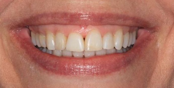 Invisalign Case 1 - After