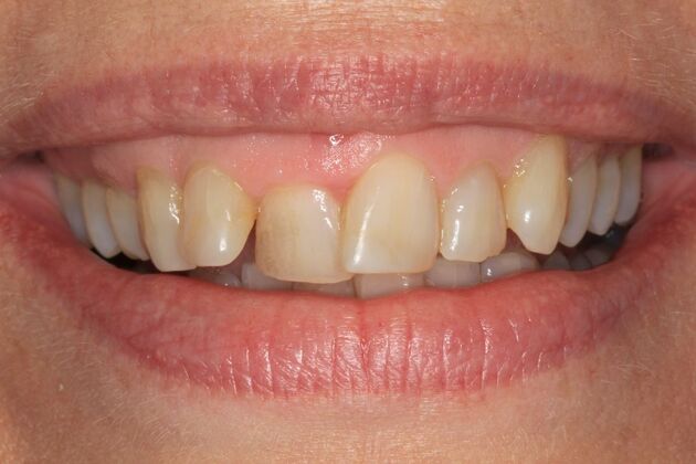 Invisalign Case 1 - Before