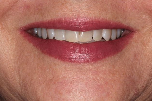 Kor Whitening: Case 4 - Before