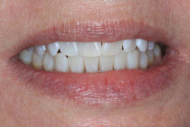 Kor Whitening: Case 4 - After