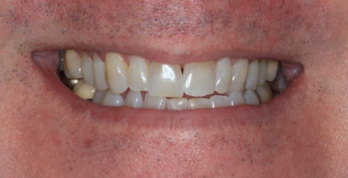 Kor Whitening Case 5 - Before