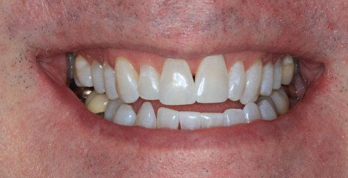 Bonding Case 6 - After