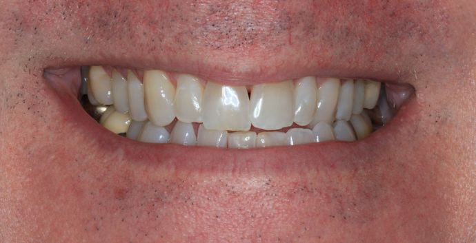 Bonding Case 6 - Before