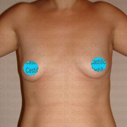 Breast Augmentation: Breast Augmentation after 12 years - Before