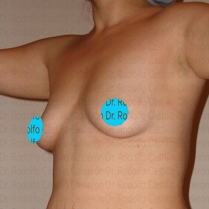 Breast Augmentation: Breast Augmentation after 12 years - Before