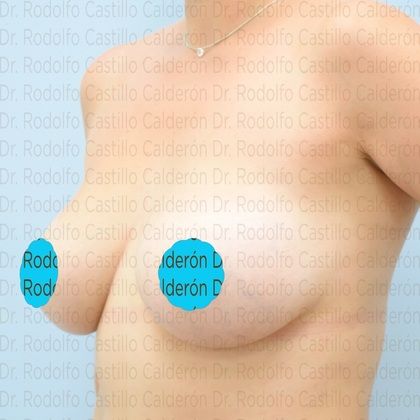 Breast Augmentation: Breast Augmentation after 12 years - After