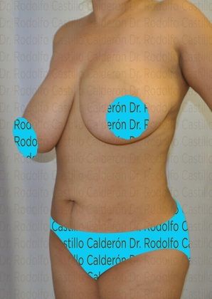 Mommy Makeover -Abdomen, Breast, Lipo, BBL-: Breast Reduction + Tummy Tuck - Before