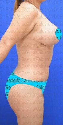 Mommy Makeover -Abdomen, Breast, Lipo, BBL-: Breast Reduction + Tummy Tuck - After