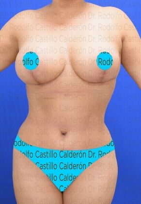 Mommy Makeover -Abdomen, Breast, Lipo, BBL-: Breast Reduction + Tummy Tuck - After