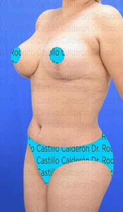 Mommy Makeover -Abdomen, Breast, Lipo, BBL-: Breast Reduction + Tummy Tuck - After