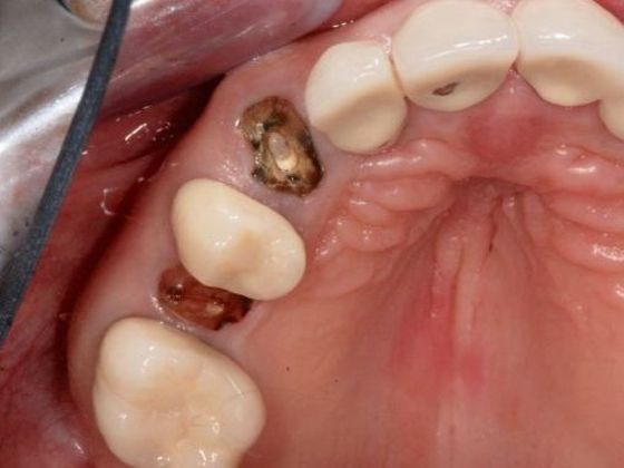 Dental Implants for Multiple Teeth Case 1 - Before