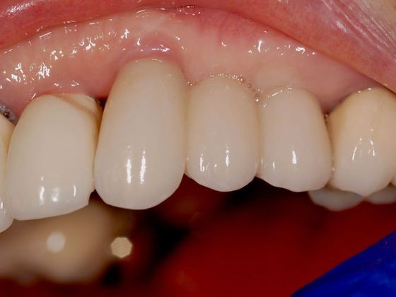 Dental Implants for Multiple Teeth Case