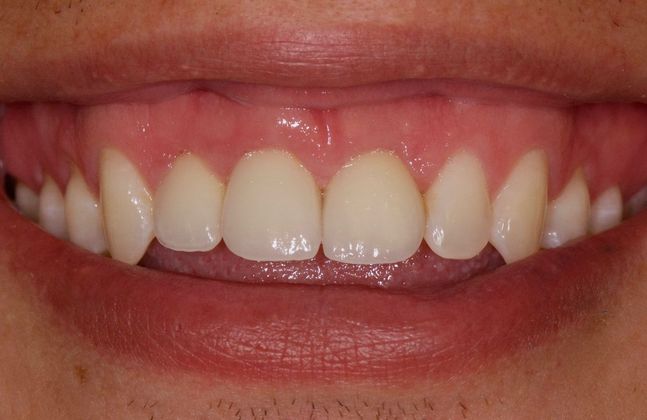 Dental Implants for Multiple Front Teeth: Case 2 - After