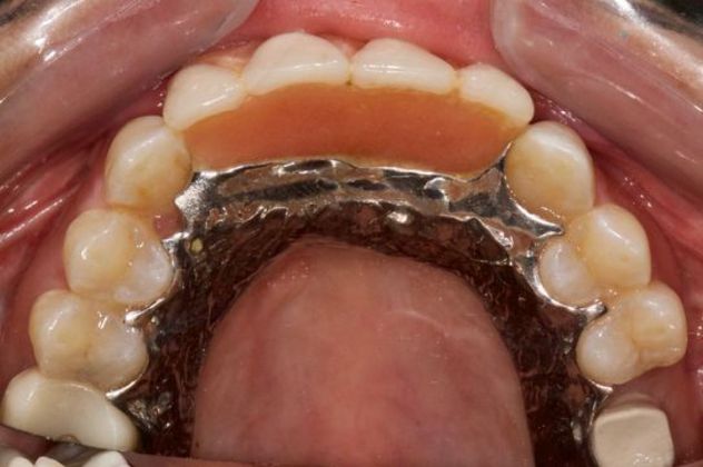 Dental Implants for Multiple Front Teeth: Case 3 - Before