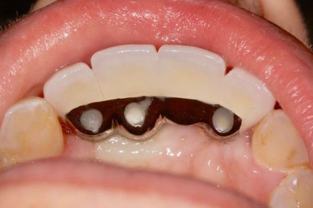 Dental Implants for Multiple Front Teeth: Case 3 - After