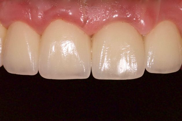 Dental Implants for Multiple Front Teeth: Case 4 - After