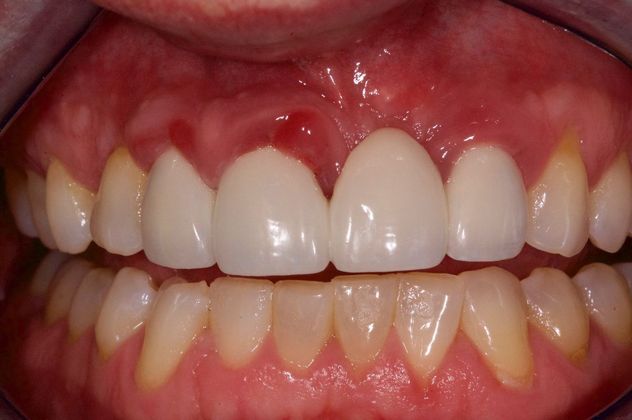 Dental Implants for Multiple Front Teeth: Case 4 - Before