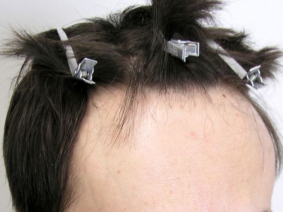 Male Before And After Hair Transplant Photos Hairline FUT (5) - Before