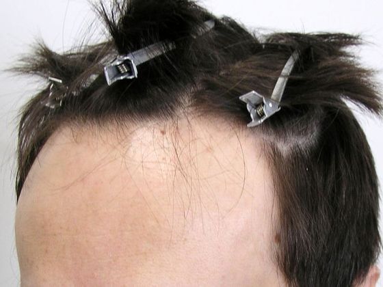 Hair Transplant - Male: Hairline FUT - Case 37 - Before FUT hair transplant