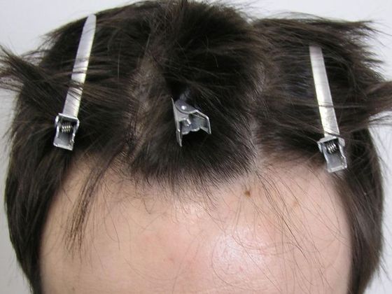 Hair Transplant - Male: Hairline FUT - Case 37 - Before FUT hair transplant