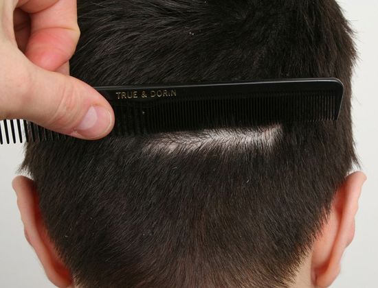 Hair Transplant - Donor Area Afters: FUT - Donor scar after FUT