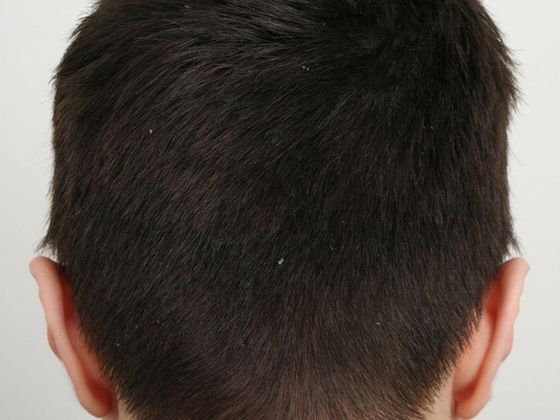 Hair Transplant - Donor Area Afters: FUT - Donor area after FUT
