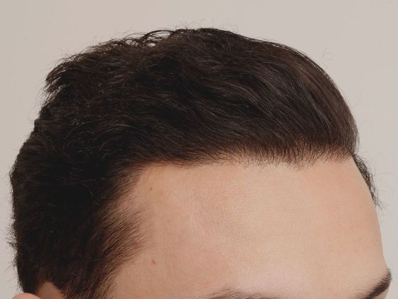 Hair Transplant - Male: Hairline FUT - Case 38 - After FUT hair transplant