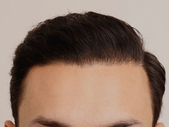 Male Before And After Hair Transplant Photos Hairline FUT (6) - After