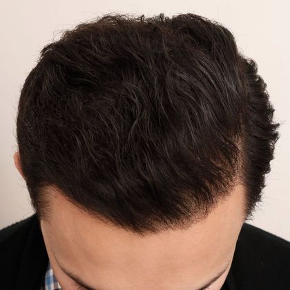 Hair Transplant - Male: Hairline FUT - Case 38 - After FUT hair transplant