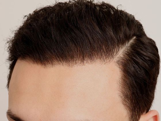 Hair Transplant - Male: Hairline FUT - Case 38 - After FUT hair transplant