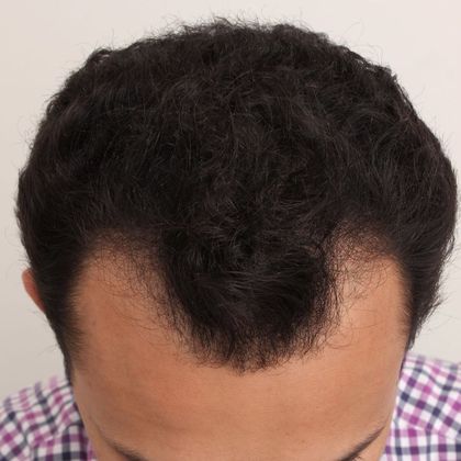 Hair Transplant - Male: Hairline FUT - Case 38 - Before FUT hair transplant