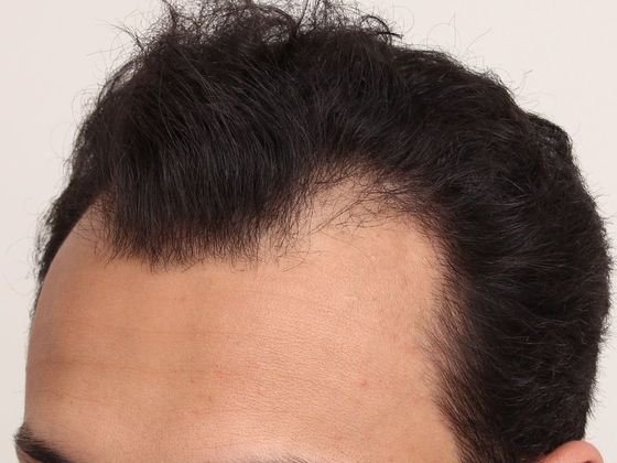 Hair Transplant - Male: Hairline FUT - Case 38 - Before FUT hair transplant